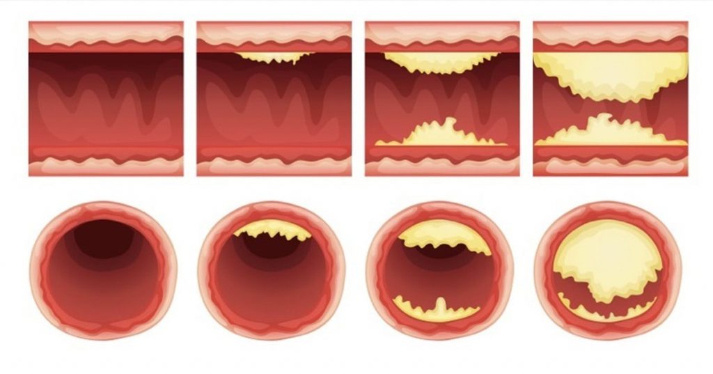 10 alimentos que desatascan las arterias naturalmente y protegen contra el ataque al corazón