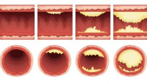 10 alimentos que desatascan las arterias naturalmente y protegen contra el ataque al corazón