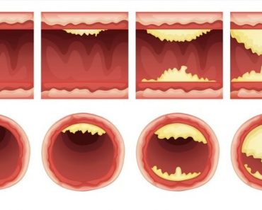 10 alimentos que desatascan las arterias naturalmente y protegen contra el ataque al corazón