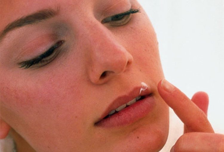 Herpes labial: Tratamiento, prevención y TODO lo que usted necesita saber