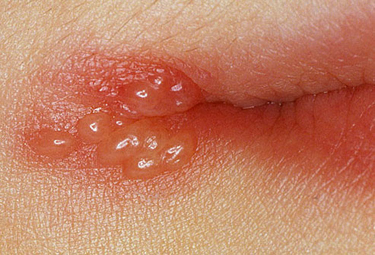 Herpes labial: Tratamiento, prevención y TODO lo que usted necesita saber