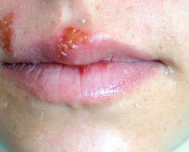 Herpes labial: Tratamiento, prevención y TODO lo que usted necesita saber Herpes labial: Tratamiento, prevención y TODO lo que usted necesita saber