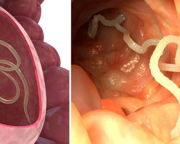 7 hierbas que matan a los parásitos internos ¡RÁPIDAMENTE!