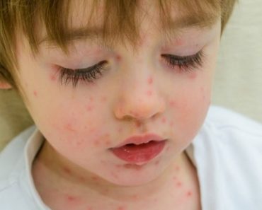 Por qué nunca debe administrar ibuprofeno a un niño con varicela