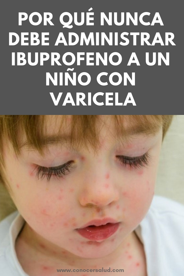 Por qué nunca debe administrar ibuprofeno a un niño con varicela