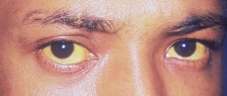 8 cosas que sus ojos están tratando de decirle acerca de su salud