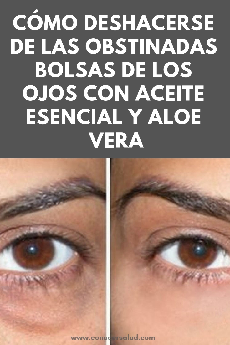 Cómo deshacerse de las obstinadas bolsas de los ojos con aceite esencial y aloe vera