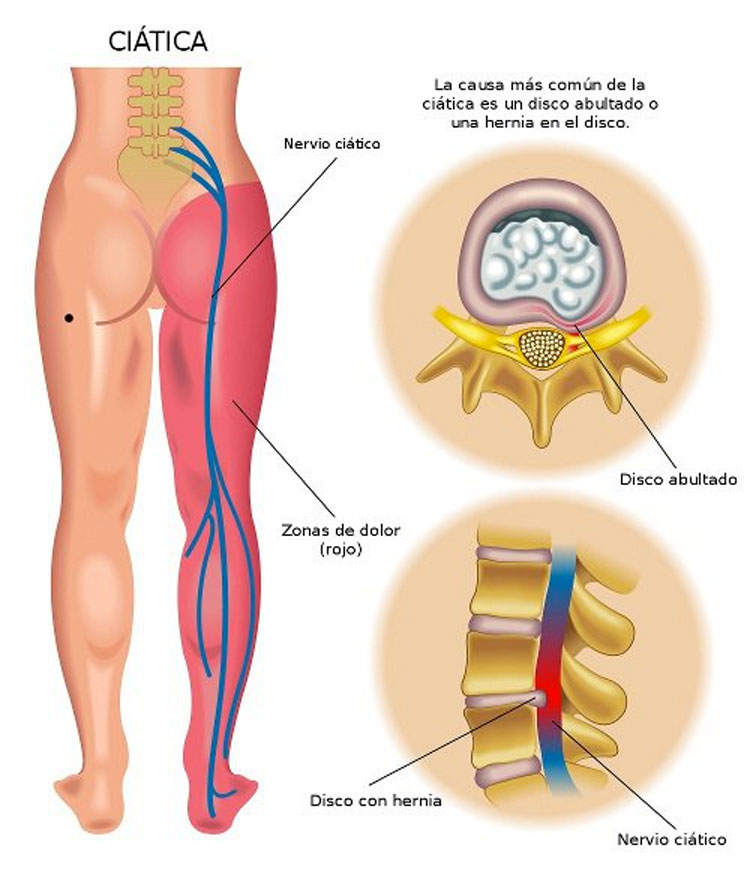 8 remedios para el dolor de ciática que necesita probar antes de poner otro analgésico en su boca