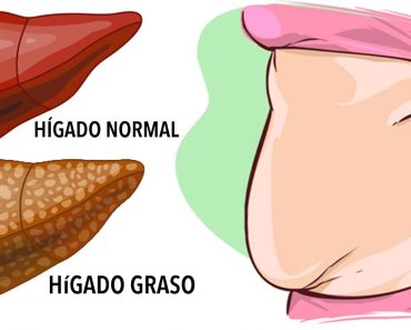 6 señales claras de advertencia de que su hígado está lleno de toxinas y está generando grasa