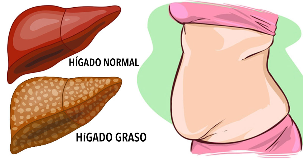 6 señales claras de advertencia de que su hígado está lleno de toxinas y está generando grasa