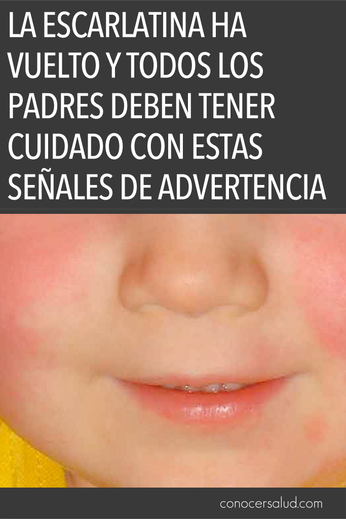 La escarlatina ha vuelto y todos los padres deben tener cuidado con estas señales de advertencia