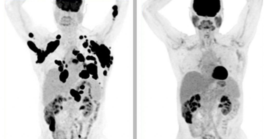 Casi el 40% de los pacientes con cáncer están en remisión después de un solo tratamiento de esta terapia génica