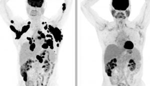 Casi el 40% de los pacientes con cáncer están en remisión después de un solo tratamiento de esta terapia génica