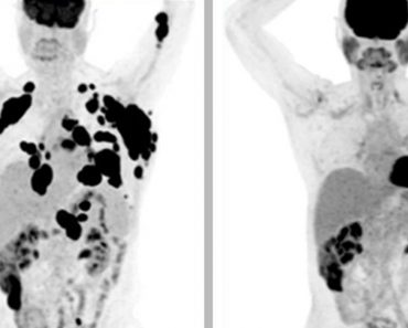 Casi el 40% de los pacientes con cáncer están en remisión después de un solo tratamiento de esta terapia génica Casi el 40% de los pacientes con cáncer están en remisión después de un solo tratamiento de esta terapia génica