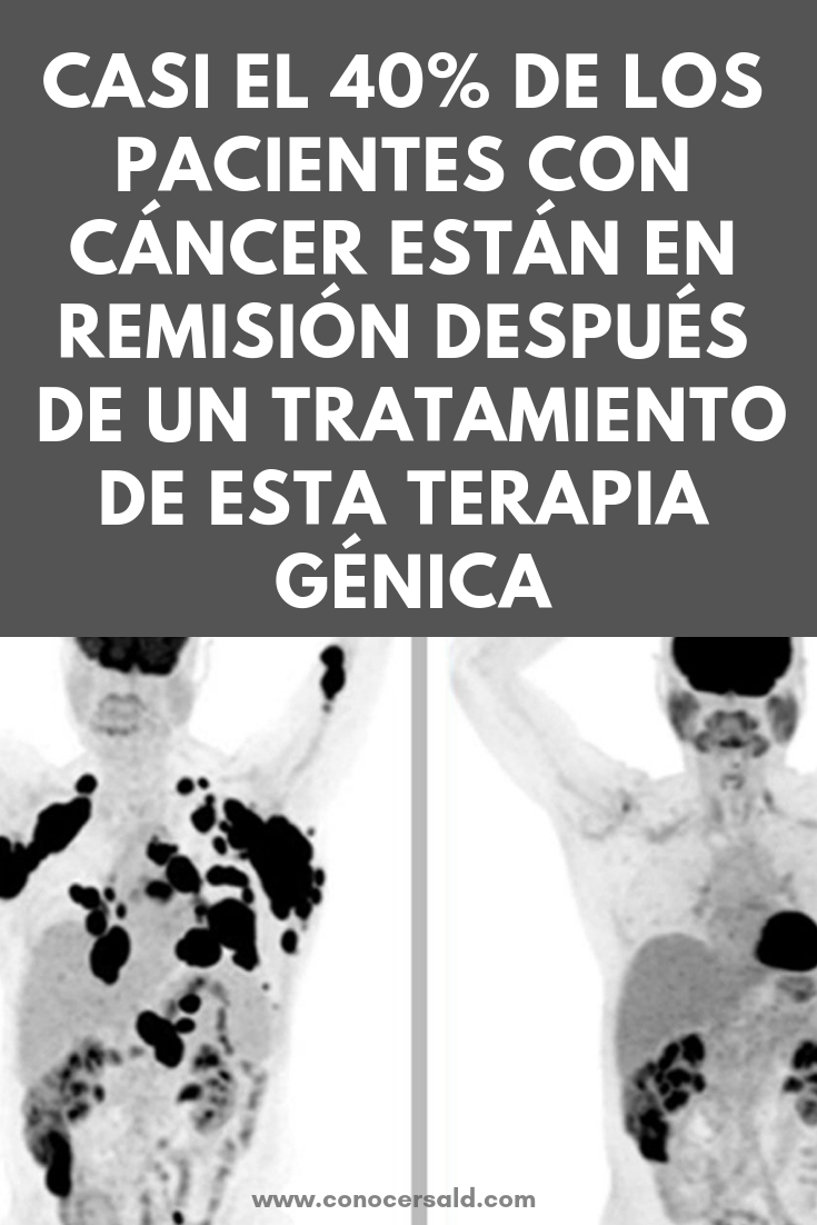 Casi el 40% de los pacientes con cáncer están en remisión después de un solo tratamiento de esta terapia génica