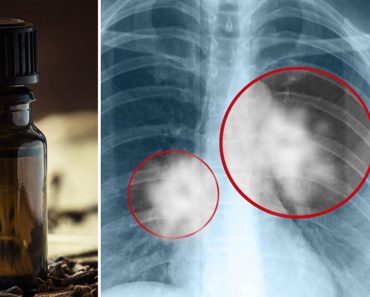 Según una investigación este aceite detiene el crecimiento del cáncer Según una investigación este aceite detiene el crecimiento del cáncer