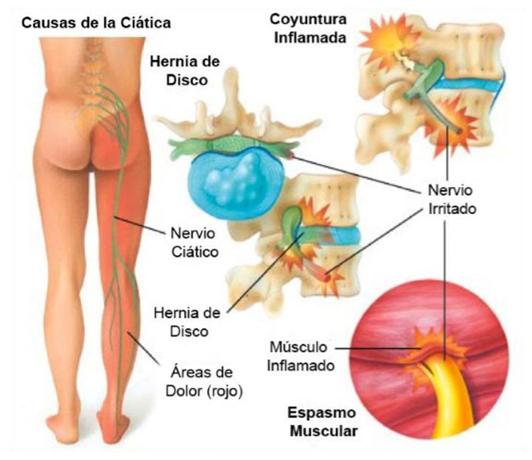 6 Tratamientos seguros y efectivos para el alivio del dolor de ciática