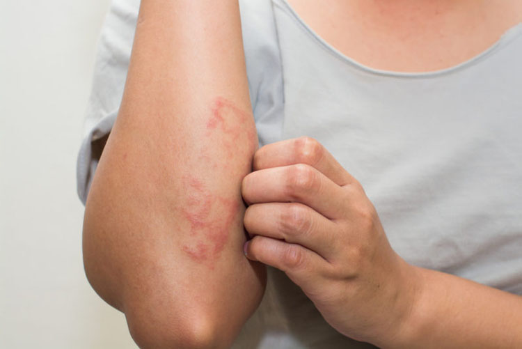 8 causas fundamentales del eczema que los doctores nunca tratan