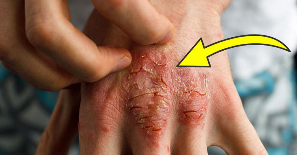 8 causas fundamentales del eczema que los doctores nunca tratan