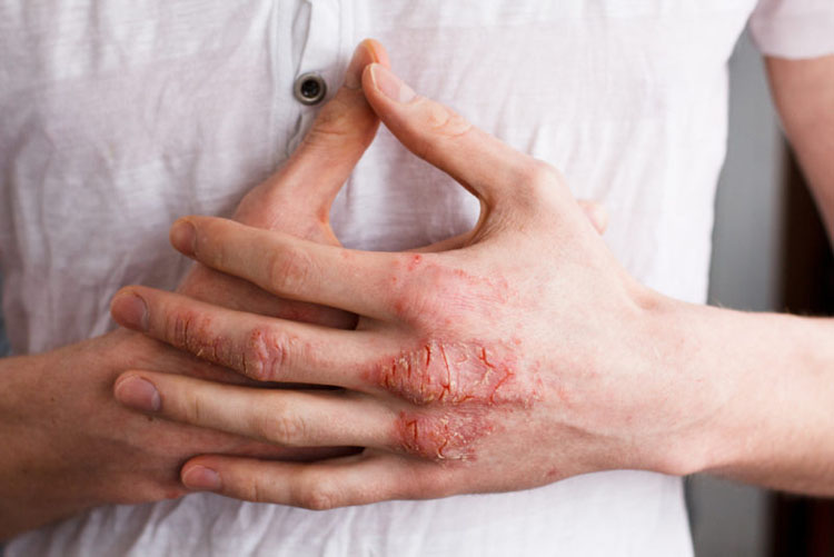 8 causas fundamentales del eczema que los doctores nunca tratan