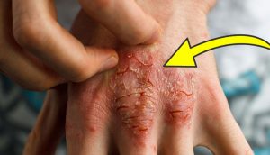 8 causas fundamentales del eczema que los doctores nunca tratan