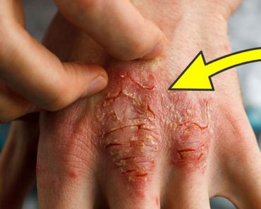 8 causas fundamentales del eczema que los doctores nunca tratan