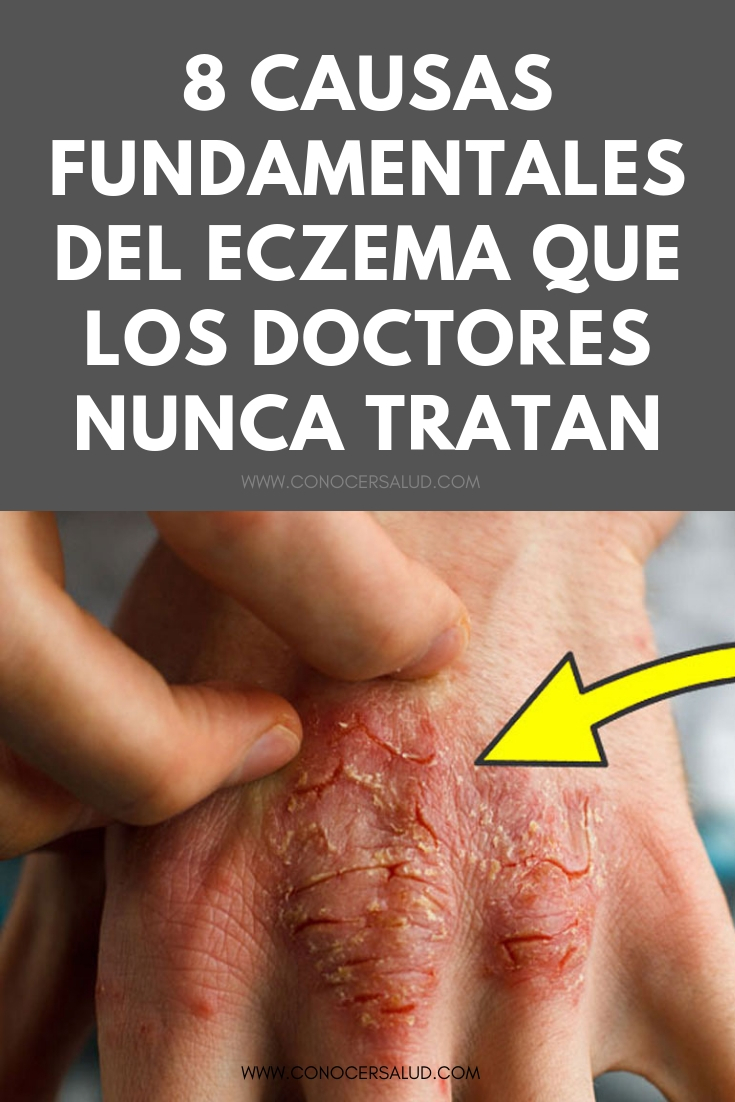 8 causas fundamentales del eczema que los doctores nunca tratan
