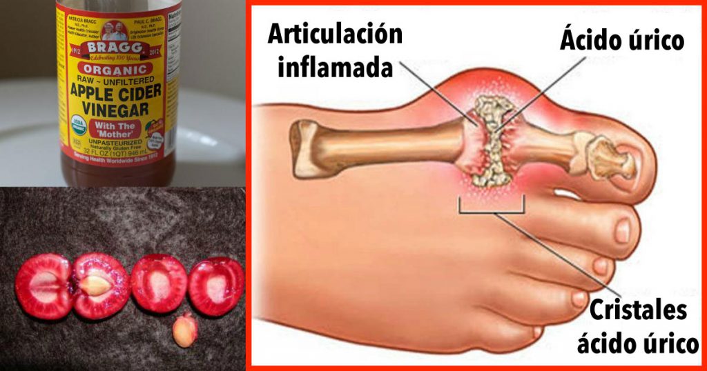 Cómo eliminar rápidamente la cristalización de ácido úrico de su cuerpo para prevenir la gota y el dolor en las articulaciones