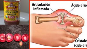 Cómo eliminar rápidamente la cristalización de ácido úrico de su cuerpo para prevenir la gota y el dolor en las articulaciones