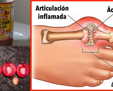 Cómo eliminar rápidamente la cristalización de ácido úrico de su cuerpo para prevenir la gota y el dolor en las articulaciones