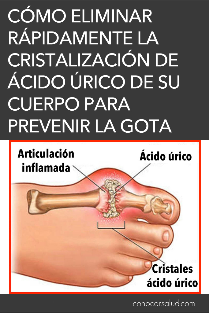 Cómo eliminar rápidamente la cristalización de ácido úrico de su cuerpo para prevenir la gota y el dolor en las articulaciones