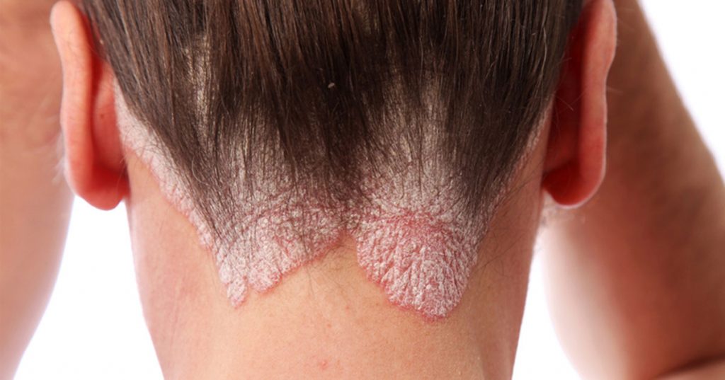 10 cosas que debe y NO debe hacer si tiene psoriasis