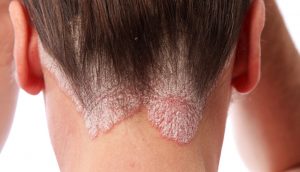 10 cosas que debe y NO debe hacer si tiene psoriasis