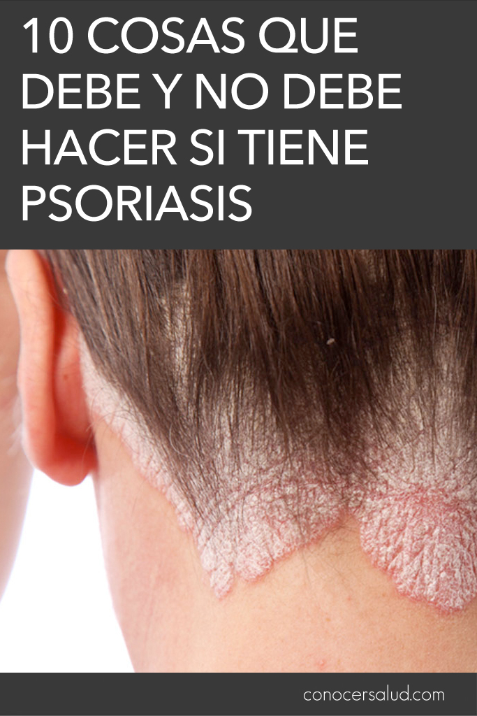 10 cosas que debe y NO debe hacer si tiene psoriasis