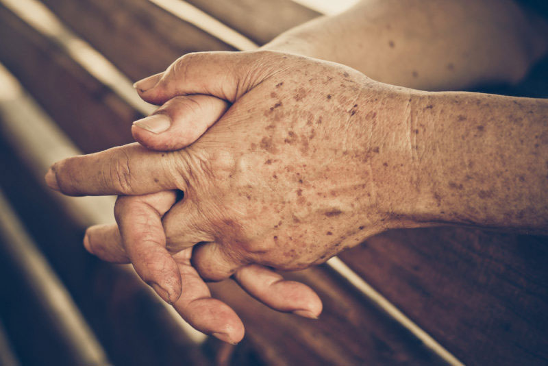 Manchas de la edad: Qué son y cómo eliminarlas de forma natural