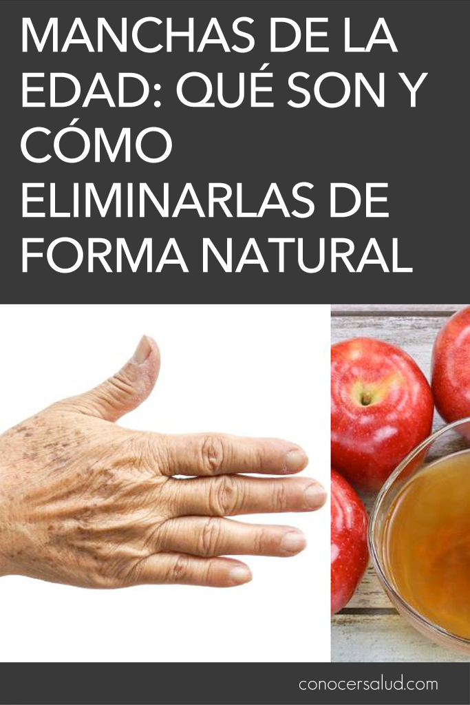 Manchas de la edad: Qué son y cómo eliminarlas de forma natural