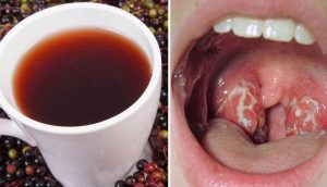 10 Remedios que acaban con las infecciones de garganta por estreptococos casi al instante