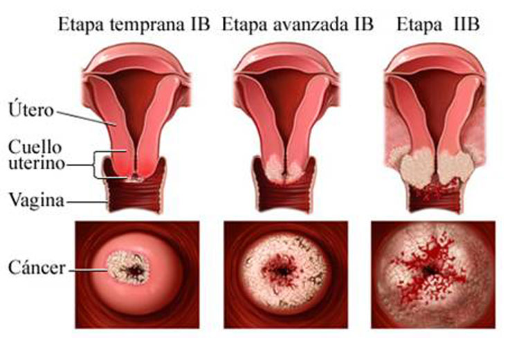 La mayoría de las mujeres ignoran estas 3 primeras señales de cáncer de cuello uterino