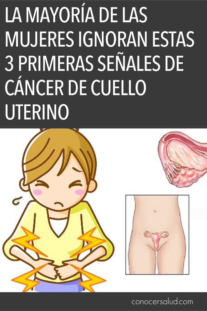 La mayoría de las mujeres ignoran estas 3 primeras señales de cáncer de cuello uterino