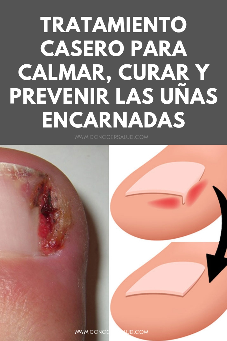 Tratamiento casero para calmar, curar y prevenir las uñas encarnadas