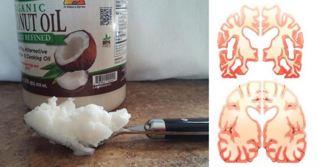 Este hombre tomaba 2 cucharadas de aceite de coco dos veces al día durante 60 días y esto le sucedió a su cerebro