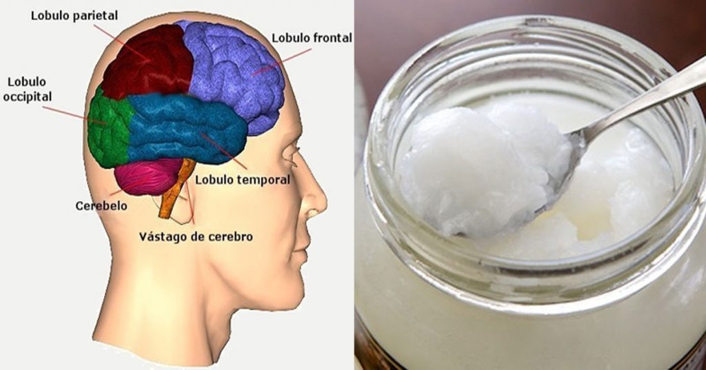 Los pacientes de Alzheimer tienen mejoras cerebrales casi inmediatas después de tomar aceite de coco