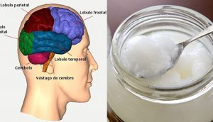 Los pacientes de Alzheimer tienen mejoras cerebrales casi inmediatas después de tomar aceite de coco