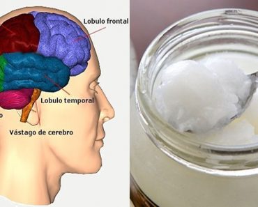 Los pacientes de Alzheimer tienen mejoras cerebrales casi inmediatas después de tomar aceite de coco