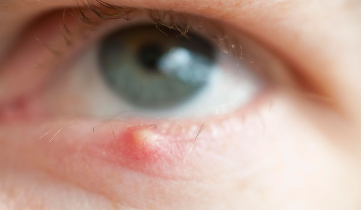 Porque Salen Bolitas En Los Ojos De Los Niños