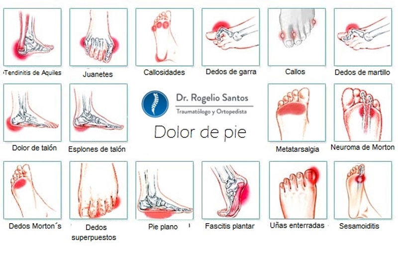 6 ejercicios para aliviar todo tipo de dolor de pies