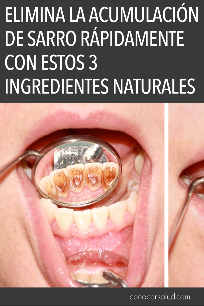 Elimina la acumulación de sarro RÁPIDAMENTE con estos 3 ingredientes naturales