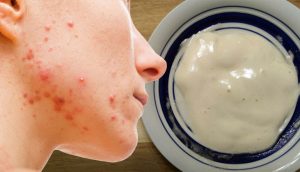 Esta mascarilla natural con ingredientes que tiene en casa ayudará a eliminar el acné y hará que tenga la piel radiante