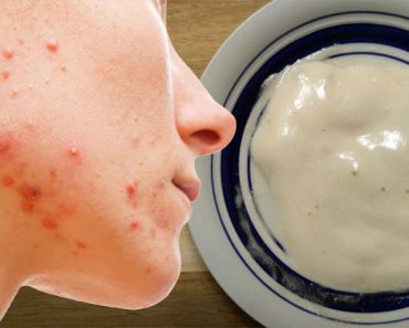 Esta mascarilla natural con ingredientes que tiene en casa ayudará a eliminar el acné y hará que tenga la piel radiante