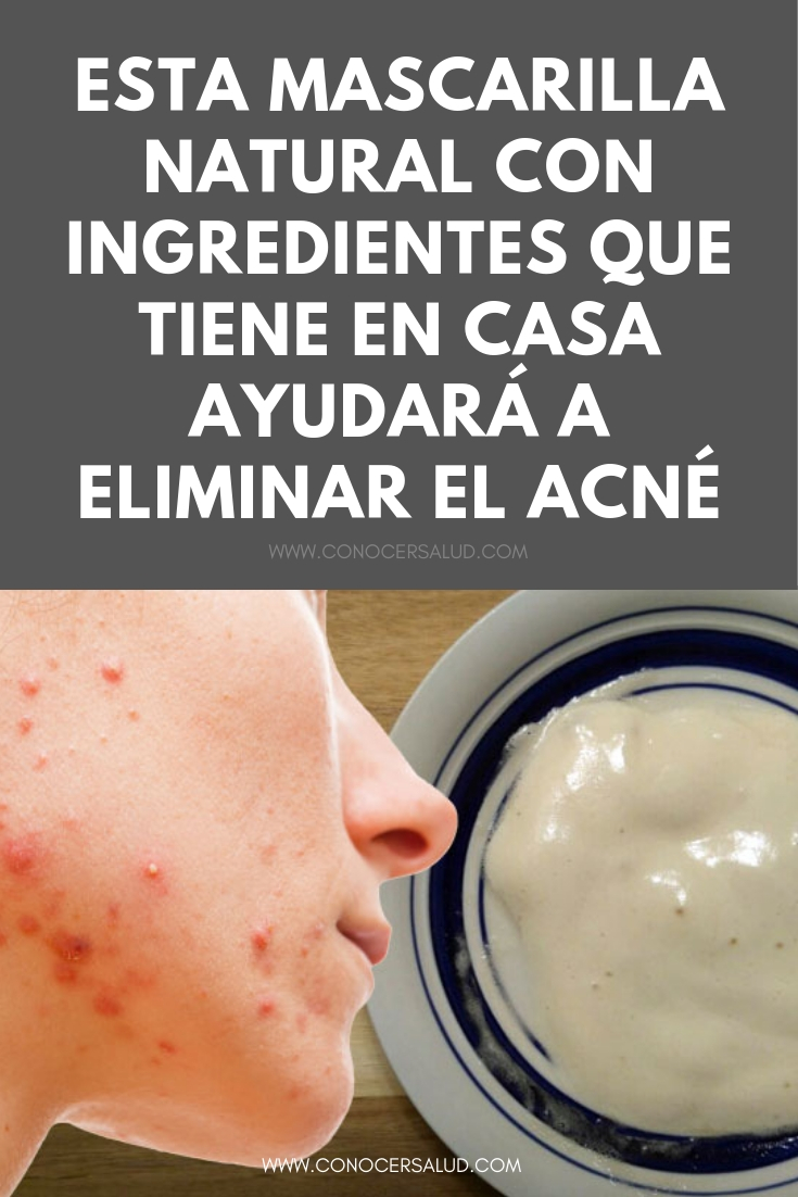 Esta mascarilla natural con ingredientes que tiene en casa ayudará a eliminar el acné y hará que tenga la piel radiante